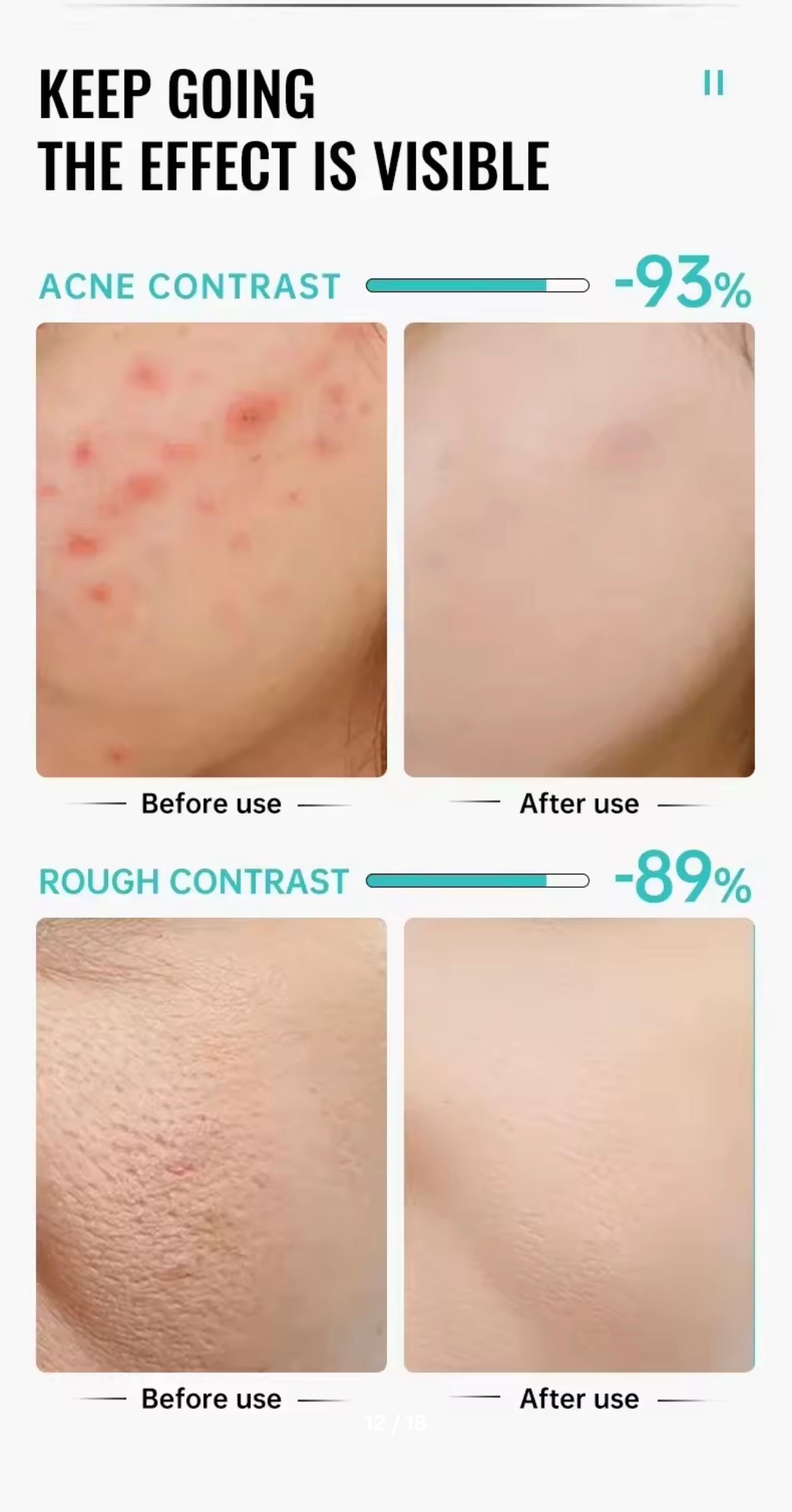 Salicylic Acid Acne Removal Cream Anti-Acne Repair Redness Pimple Spots Deep Cleaning Pore Oil Control Moisturizing Skin Care