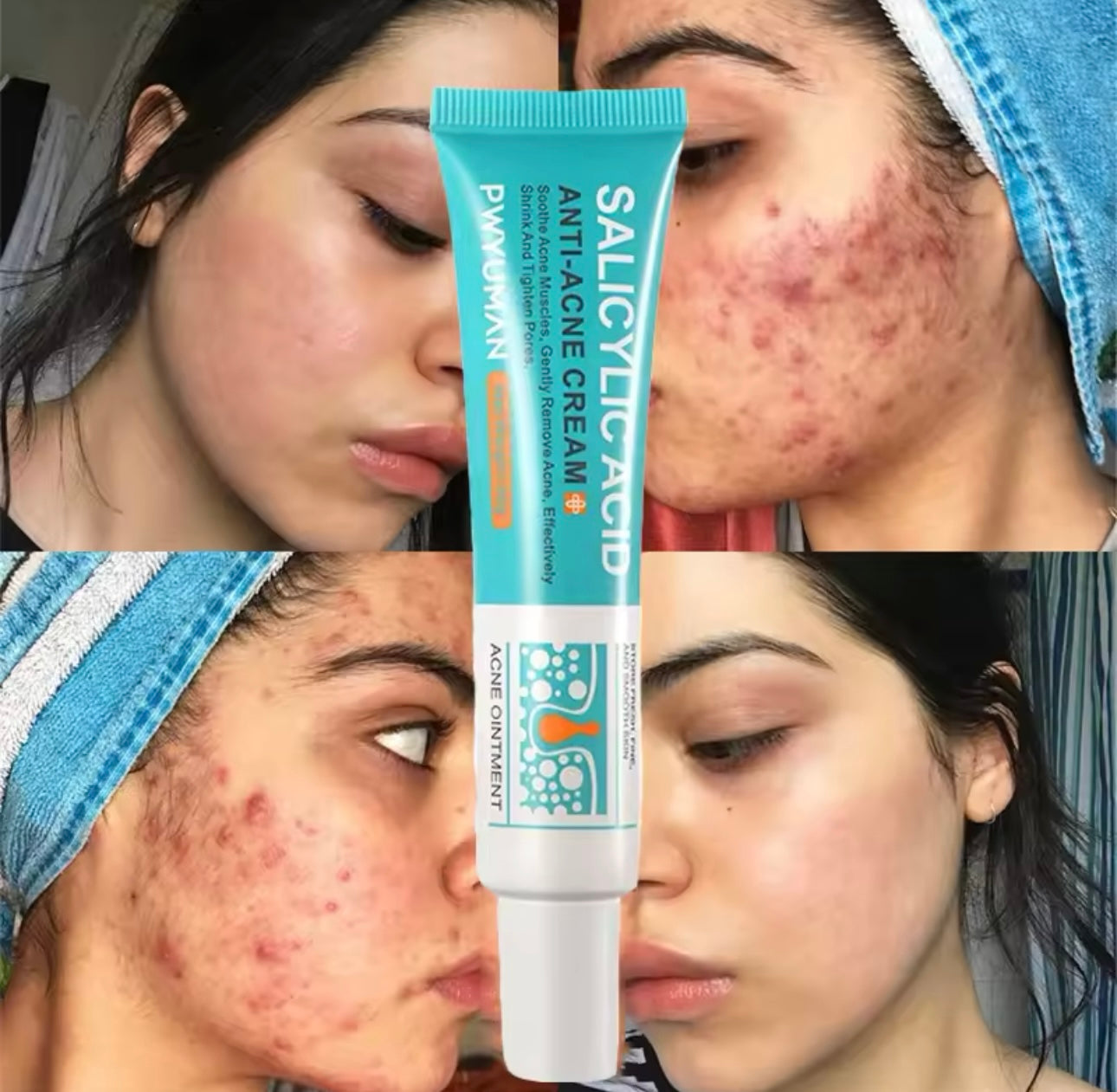 Salicylic Acid Acne Removal Cream Anti-Acne Repair Redness Pimple Spots Deep Cleaning Pore Oil Control Moisturizing Skin Care