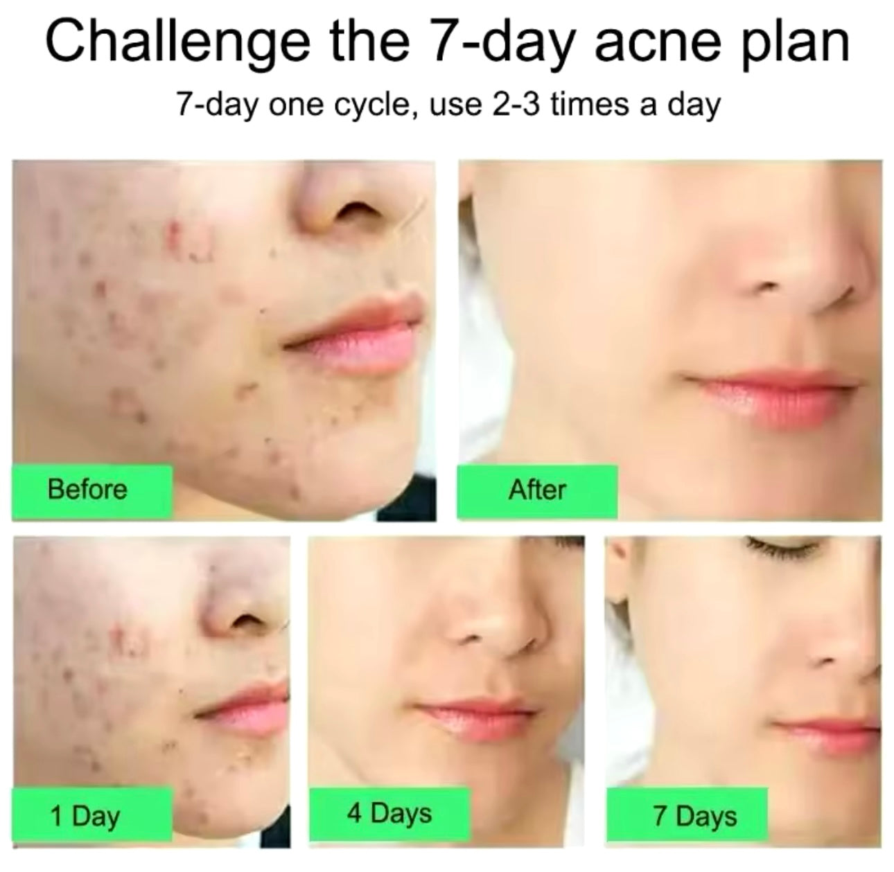 Salicylic Acid Acne Removal Cream Anti-Acne Repair Redness Pimple Spots Deep Cleaning Pore Oil Control Moisturizing Skin Care