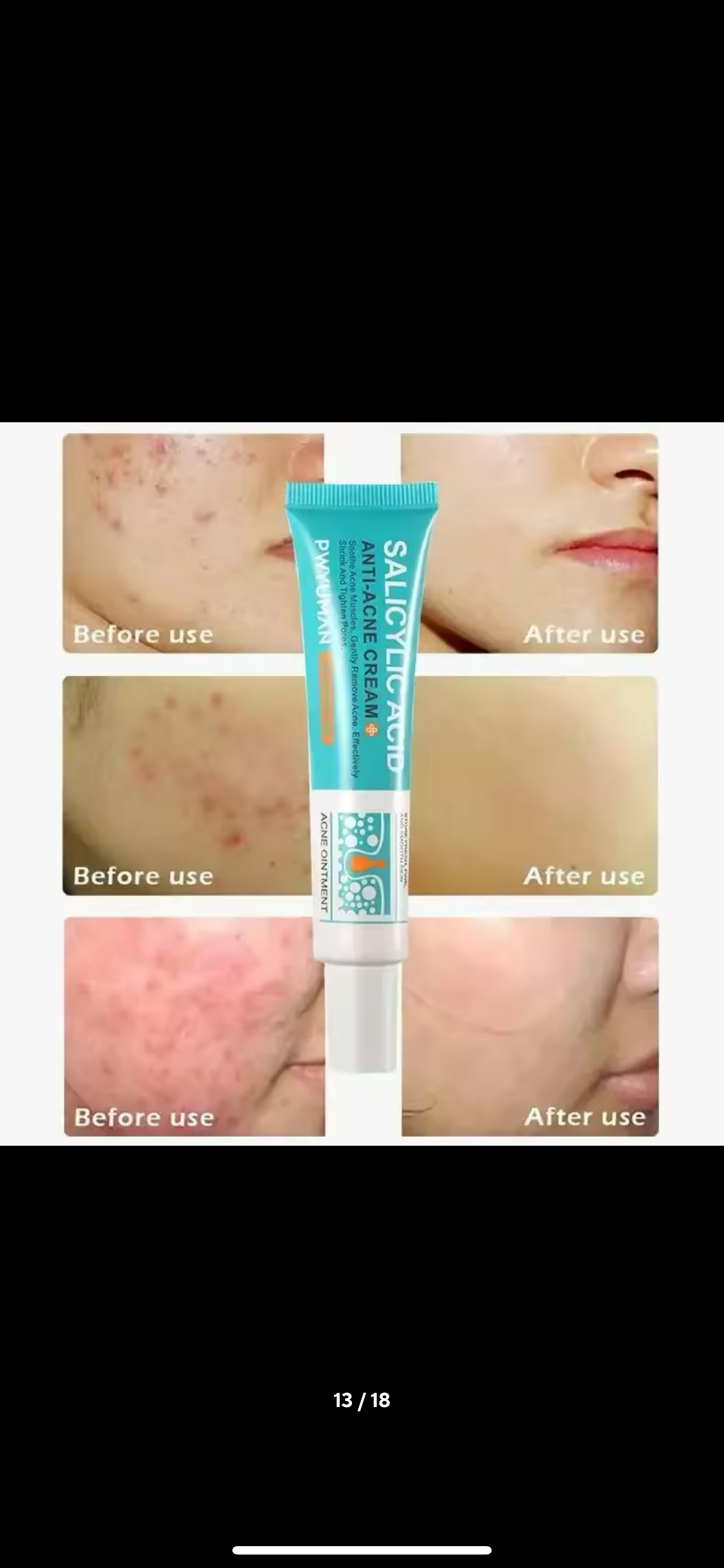 Salicylic Acid Acne Removal Cream Anti-Acne Repair Redness Pimple Spots Deep Cleaning Pore Oil Control Moisturizing Skin Care